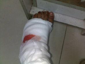 脚受伤视频,视频揭示运动损伤全过程